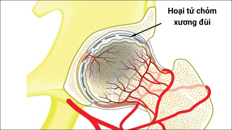 Hoại tử vô mạch là một bệnh lý về xương nguy hiểm Hoại tử vô mạch là một bệnh lý về xương nguy hiểm