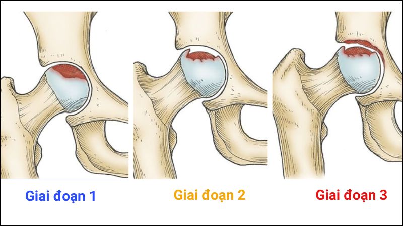 Hoại tử vô mạch không được phát hiện sớm cho thể dẫn tới hoại tử xương Hoại tử vô mạch không được phát hiện sớm cho thể dẫn tới hoại tử xương