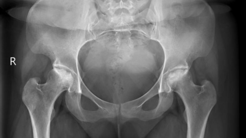 X-quang có thể giúp chẩn đoán hoại tử vô mạch X-quang có thể giúp chẩn đoán hoại tử vô mạch