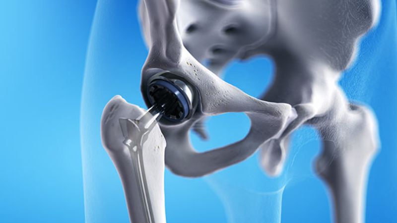 Thay khớp nhân tạo có thể được chỉ định nếu xương bị tổn thương nghiêm trọng Thay khớp nhân tạo có thể được chỉ định nếu xương bị tổn thương nghiêm trọng