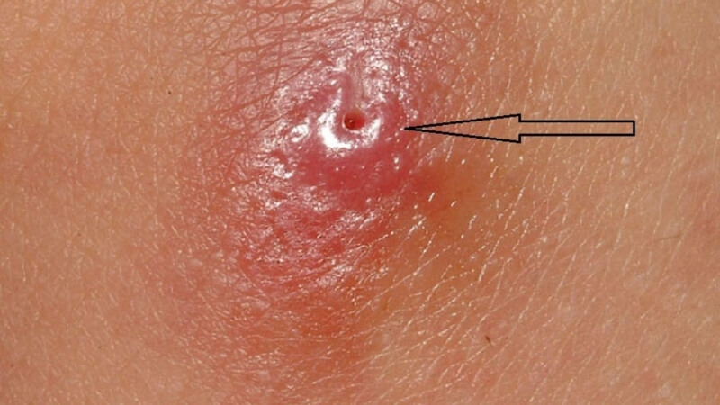 Nhiễm trùng giòi maggot ngoài da là dạng phổ biến nhất Nhiễm trùng giòi maggot ngoài da là dạng phổ biến nhất