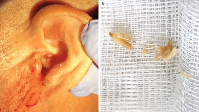 Giòi maggot có thể phát triển ở khoang tai Giòi maggot có thể phát triển ở khoang tai