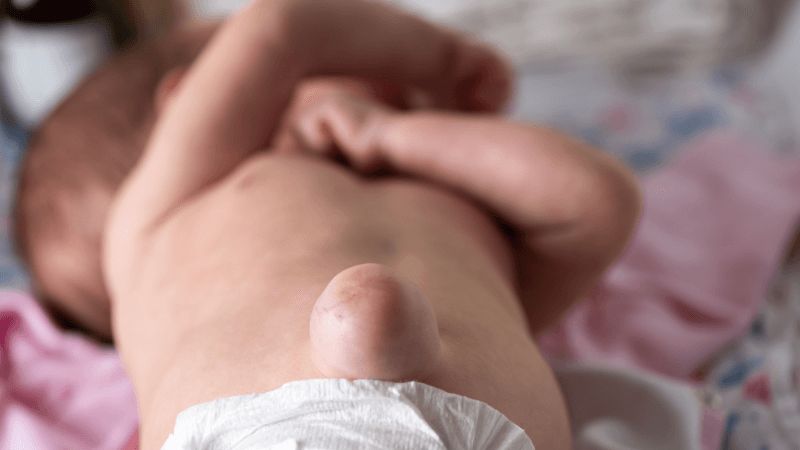 Nếu lỗ mở không đóng lại hoàn toàn thì có thể sẽ xảy ra thoát vị rốn Nếu lỗ mở không đóng lại hoàn toàn thì có thể sẽ xảy ra thoát vị rốn