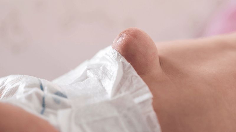 Thoát vị rốn thường xảy ra phổ biến ở trẻ nhỏ. Thoát vị rốn thường xảy ra phổ biến ở trẻ nhỏ.