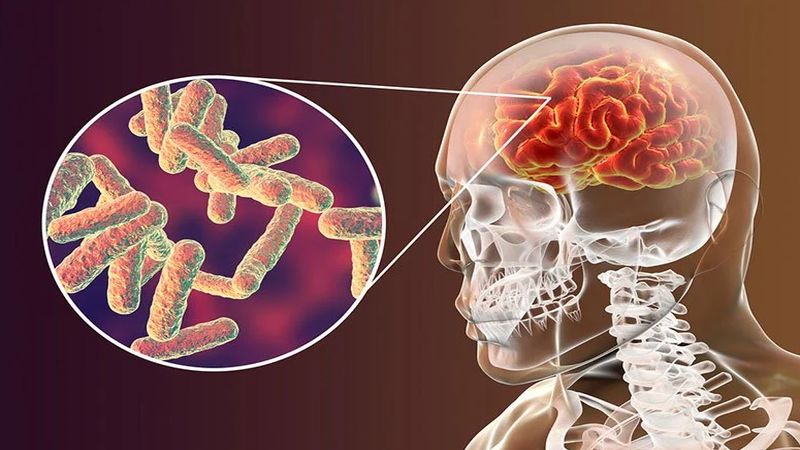 Vi khuẩn lao xâm nhập vào não và tủy sống gây bệnh lao màng não Vi khuẩn lao xâm nhập vào não và tủy sống gây bệnh lao màng não