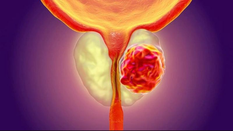 Người bệnh lao tuyến tiền liệt có thể gặp triệu chứng tiểu khó