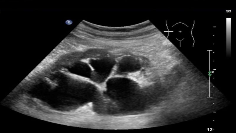 Siêu âm sẽ giúp phát hiện tình trạng thận ứ nước 