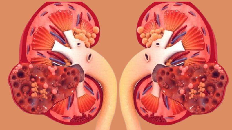 Bệnh thận bột hình thành do sự tích tự amylosid trong thận