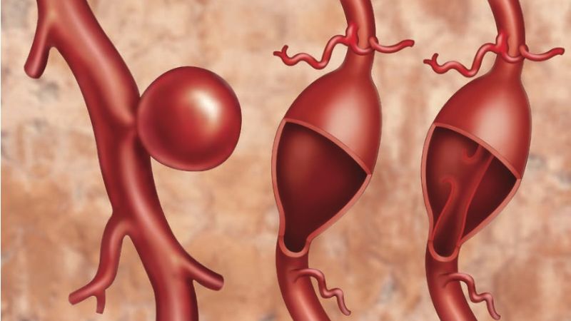 Phình động mạch chủ ngực xảy ra khi thành mạch suy yếu và hình thành túi phình