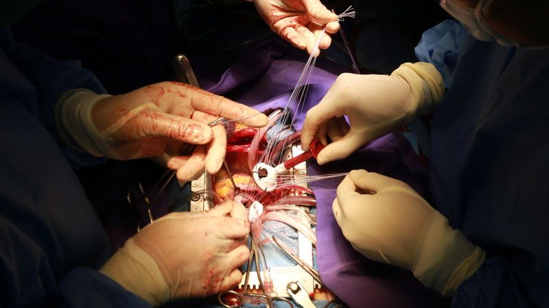 Phẫu thuật là phương pháp điều trị dứt điểm phình động mạch chủ ngực