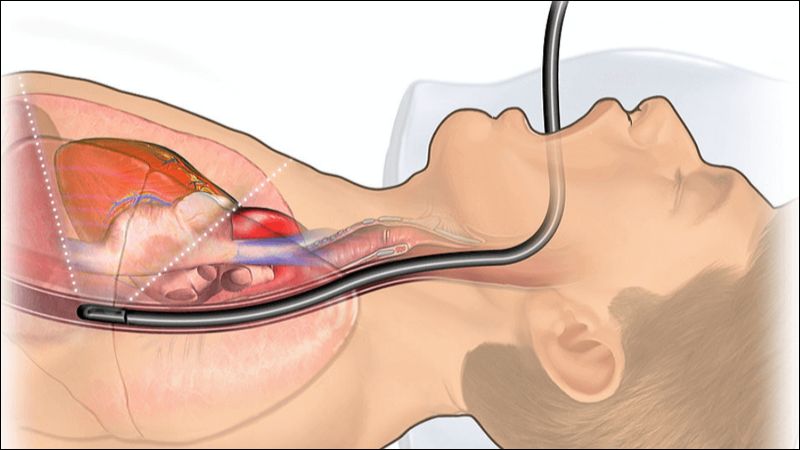 Siêu âm tim qua thực quản có thể cung cấp hình ảnh với góc nhìn tốt hơn