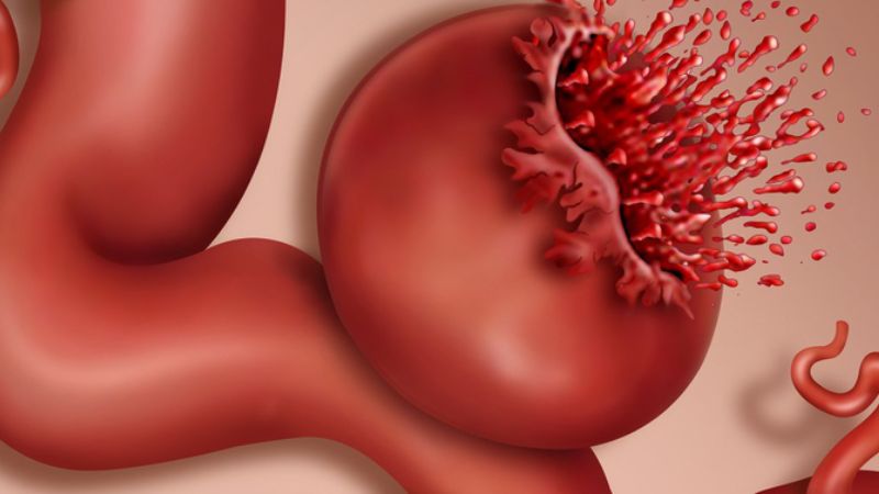 Vỡ phình động mạch chủ là một trường hợp cần cấp cứu khẩn cấp