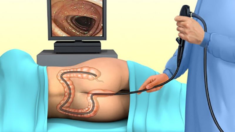 Nội soi là tiêu chuẩn vàng chẩn đoán trĩ tắc mạch
