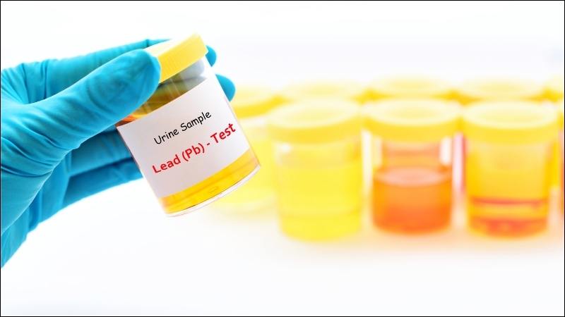 Chẩn đoán nhiễm độc chì chủ yếu dựa vào xét nghiệm Delta ALA niệu Chẩn đoán nhiễm độc chì chủ yếu dựa vào xét nghiệm Delta ALA niệu