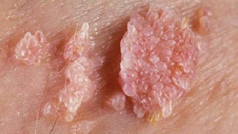Sùi mào gà là một bệnh xã hội nguy hiểm gây ra bởi virus HPV