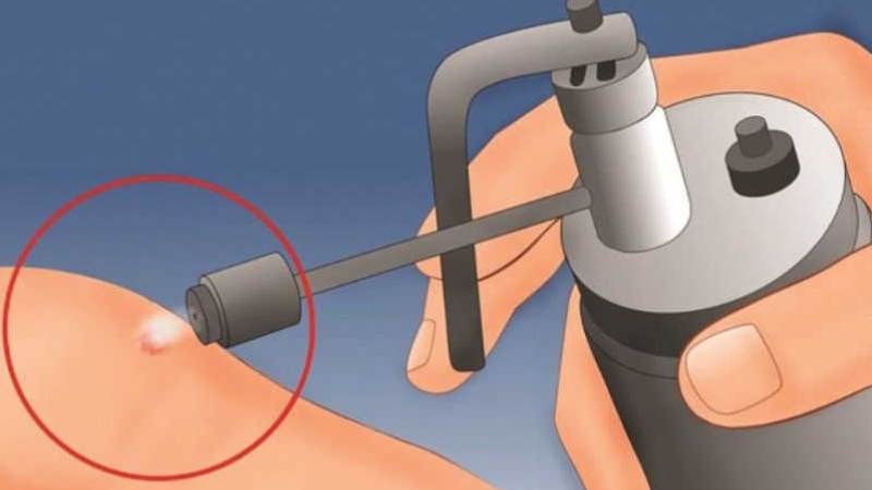 Áp lạnh bằng nitơ lỏng là phương pháp điều trị sùi mào gà được sử dụng nhiều hiện nay