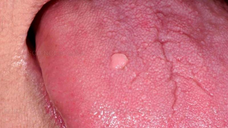 Sùi mào gà ở lưỡi giai đoạn đầu rất khó nhận biết 