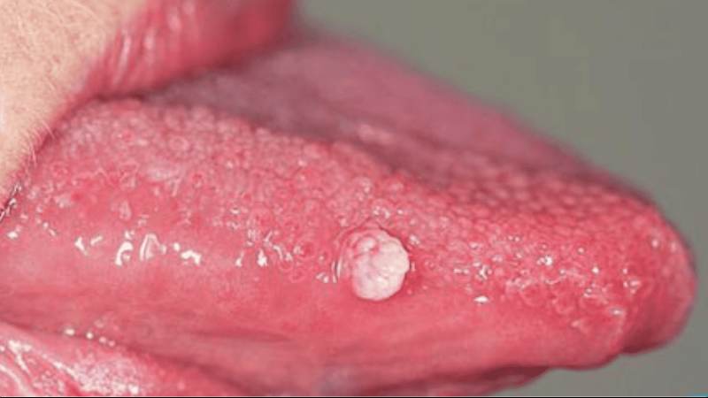 Triệu chứng của sùi mào gà ở lưỡi giai đoạn 2 biểu hiện rõ hơn với các vết sần nổi cộm trên lưỡi