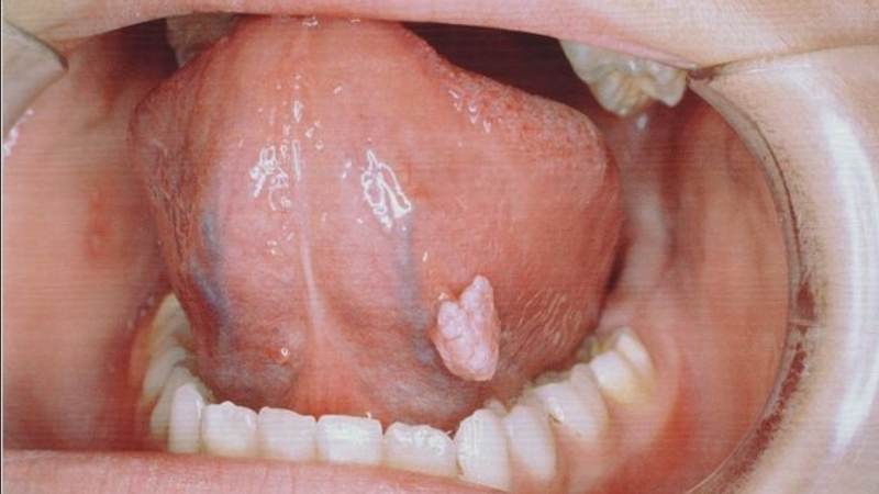 Sùi mào gà ở lưỡi giai đoạn 3 là giai đoạn nặng nhất, tiềm ẩn nhiều biến chứng