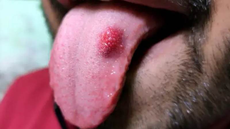 Sùi mào gà ở lưỡi rất dễ lây lan và tiến triển nhanh nên cần được phát hiện, điều trị kịp thời