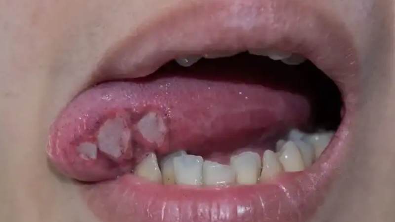 Biến chứng nghiêm trọng của sùi mào gà ở lưỡi là ung thư