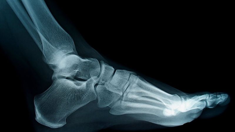 Chụp X-quang giúp chẩn đoán nguyên nhân gây hội chứng bàn chân bẹt 