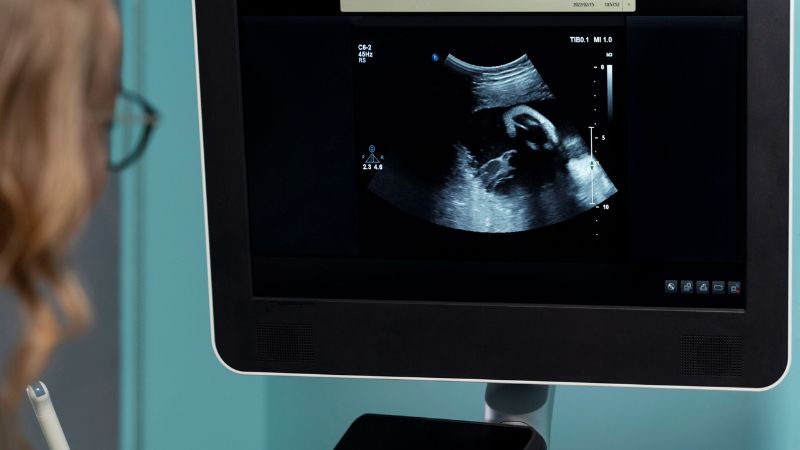 Hội chứng apert có thể được sàng lọc trước sinh Hội chứng apert có thể được sàng lọc trước sinh