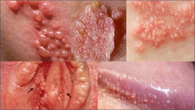 Ở nam giới, sùi mào gà thường có hình dáng giống mào gà