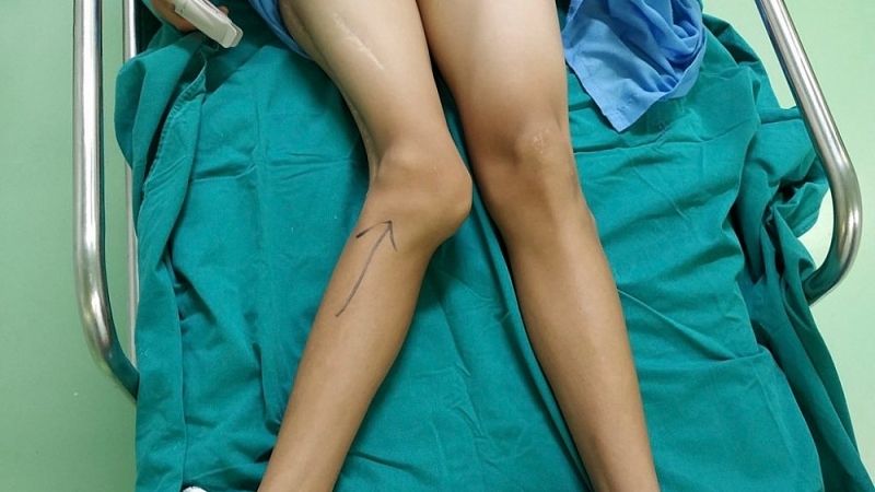 Biến dạng chi là dấu hiệu cảnh báo cần gặp bác sĩ ngay 