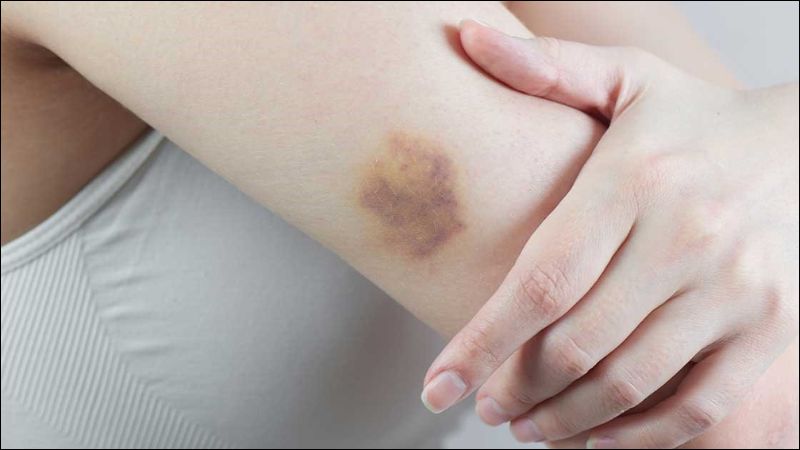 Bầm tím xảy ra khi có tổn thương mạch máu gay xuất huyết dưới da