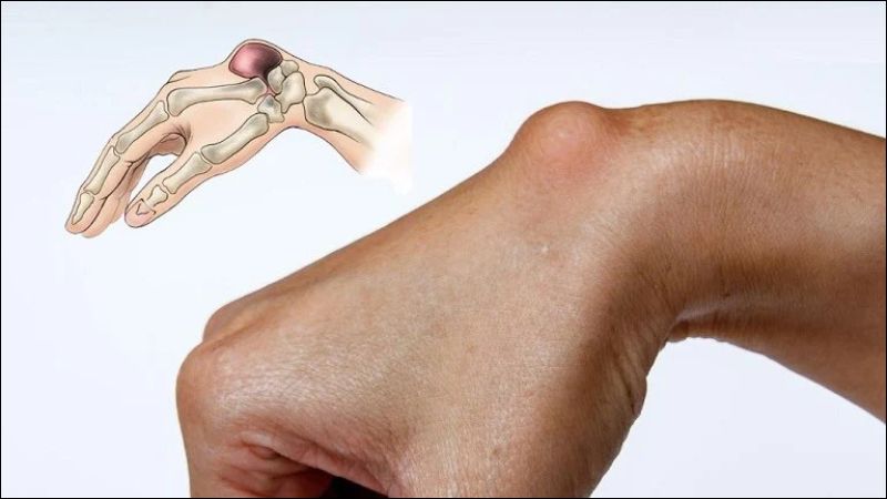 Viêm bao hoạt dịch là tình trạng viêm các dải xơ bao quanh khớp    
