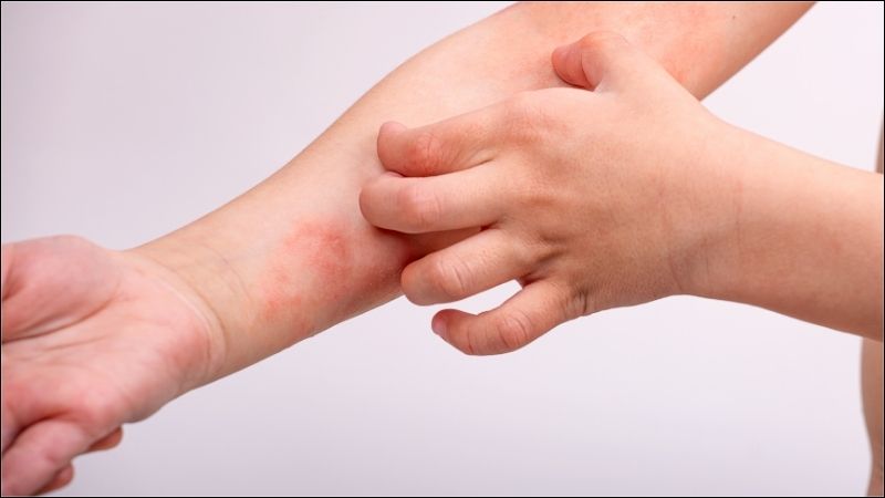 Viêm da dị ứng là một bệnh mạn tính