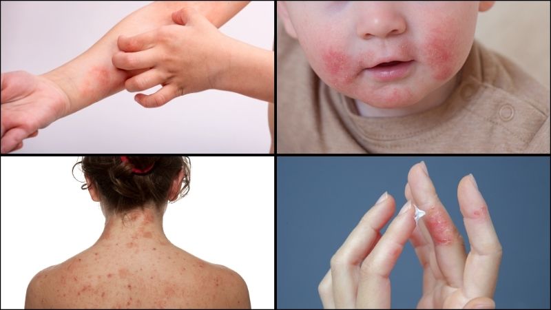 Viêm da dị ứng được phân thành nhiều loại