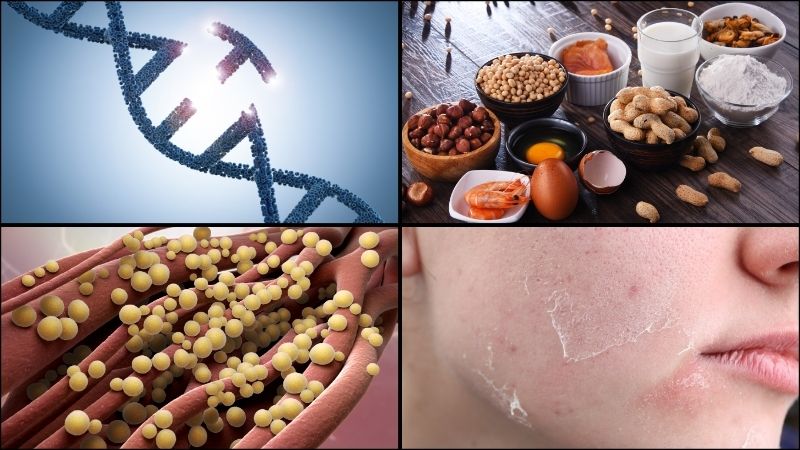 Viêm da dị ứng là bệnh da liễu do nhiều yếu tố kết hợp gây ra