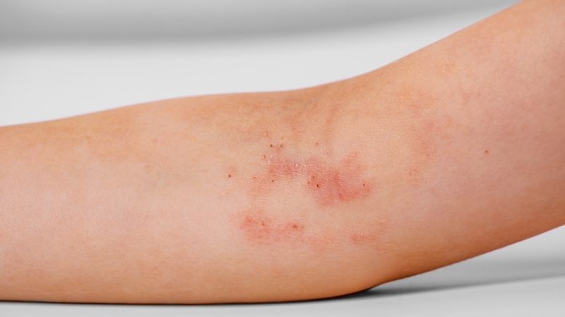 Triệu chứng viêm da dị ứng có thể khác nhau ở mỗi người