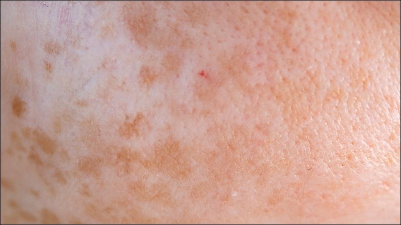 Viêm da dị ứng có thể dẫn đến nhiều biến chứng