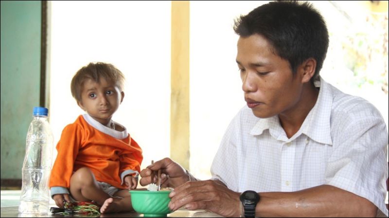 Hội chứng Seckel còn được gọi là hội chứng người tí hon   