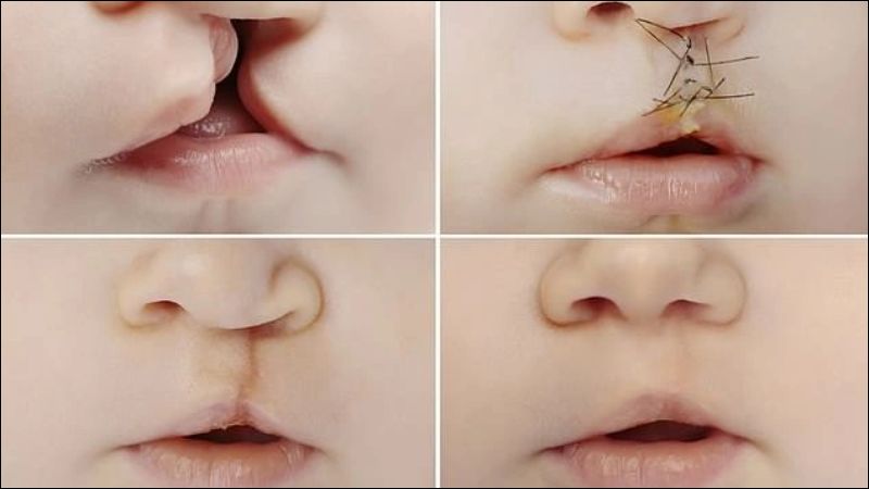 Dị tật hở hàm ếch ở trẻ mắc hội chứng Seckel có thể được điều trị bằng phẫu thuật 