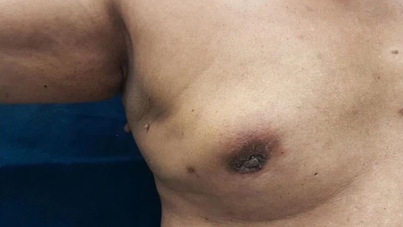 Da vú nhăn nheo và núm vú bị tụt vào có thể là dấu hiệu của ung thư vú