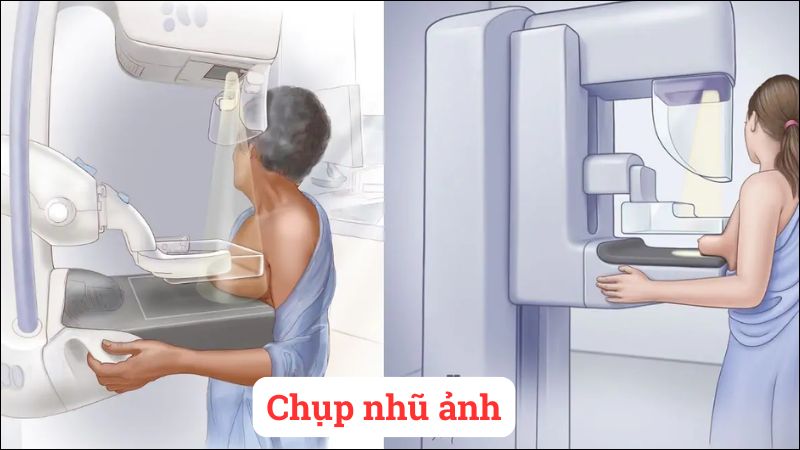 Chụp ngũ ảnh giúp phát hiện ung thư vú