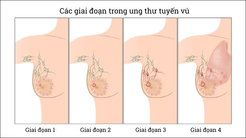 Phân giai đoạn ung thư vú giúp lựa chọn phương pháp điều trị phù hợp