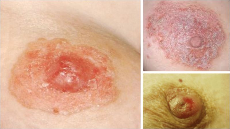 Bệnh Paget ở núm vú là một dạng ung thư vú hiếm gặp