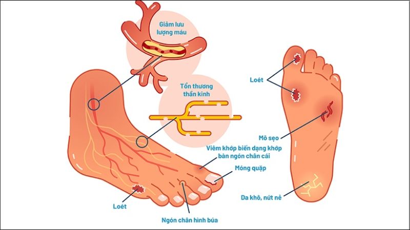 Bàn chân đái tháo đường là biến chứng khi bệnh tiểu đường không được kiểm soát tốt