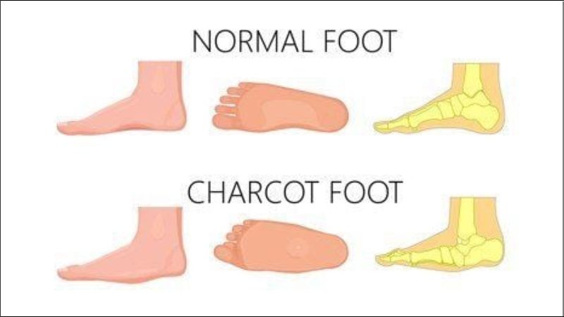 Bàn chân Charcot là biến chứng hiếm gặp do tổn thương thần kinh liên quan đến tiểu đường