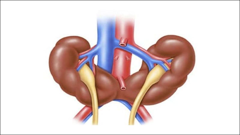 Thận móng ngựa là một dị tật bẩm sinh Thận móng ngựa là một dị tật bẩm sinh