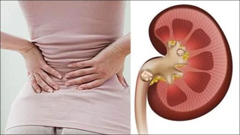 Sỏi thận là một biến chứng thường gặp của thận móng ngựa Sỏi thận là một biến chứng thường gặp của thận móng ngựa