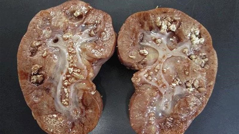 Thận móng ngựa thường đi kèm với sỏi thận Thận móng ngựa thường đi kèm với sỏi thận
