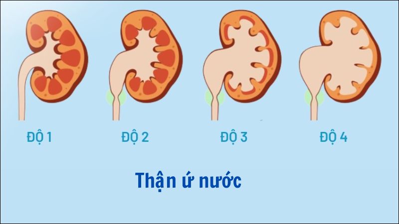 Thận ứ nước có thể gặp ở bệnh thận móng ngựa Thận ứ nước có thể gặp ở bệnh thận móng ngựa