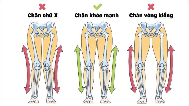 Chân vòng kiềng là tình trạng hai chân cong ra ngoài khiến hai đầu gối xa nhau