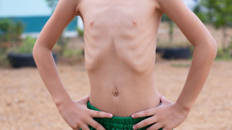 Còi xương có thể dẫn đến chan vòng kiềng